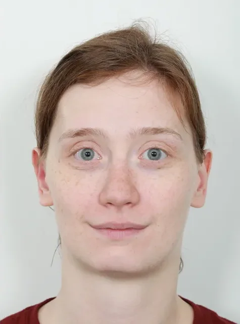 Photo of actual Otoplasty patient after procedure