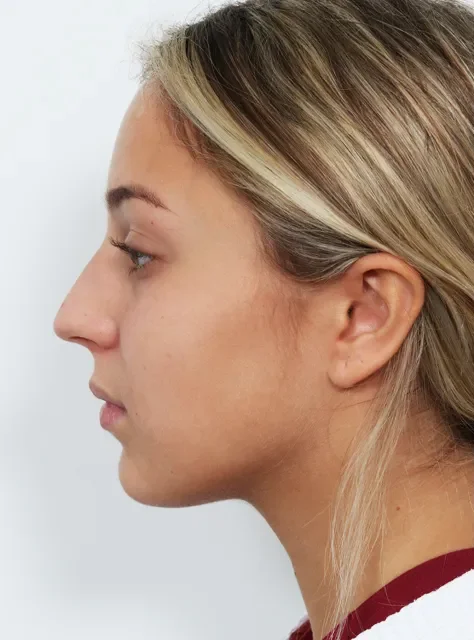 Profile photo of actual Rhinoplasty patient before procedure