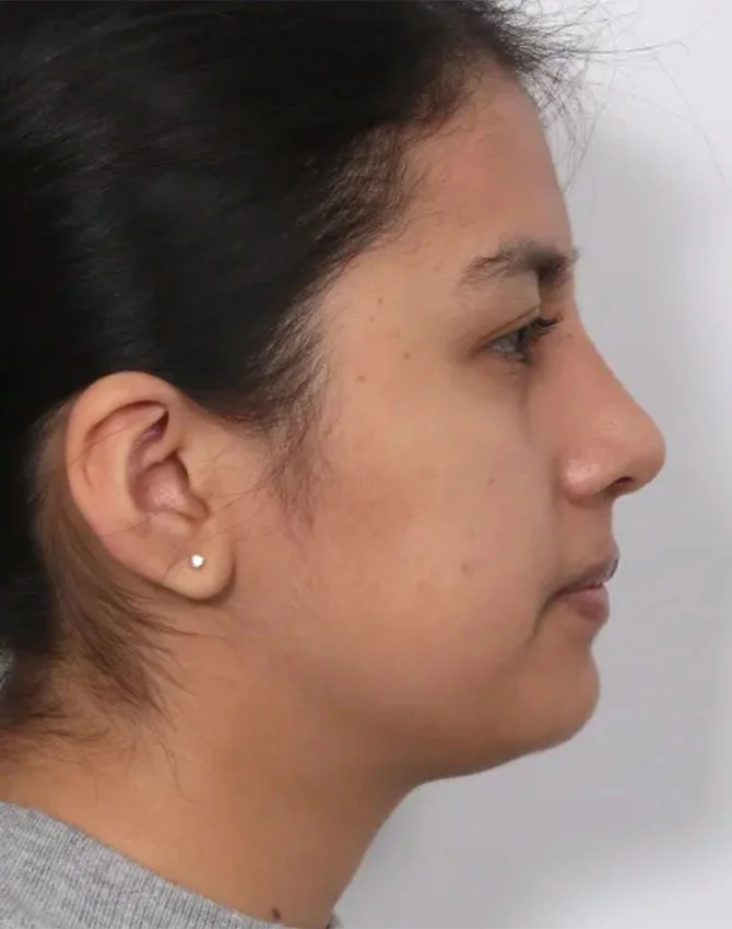 Real female patient after Rhinoplasty surgery