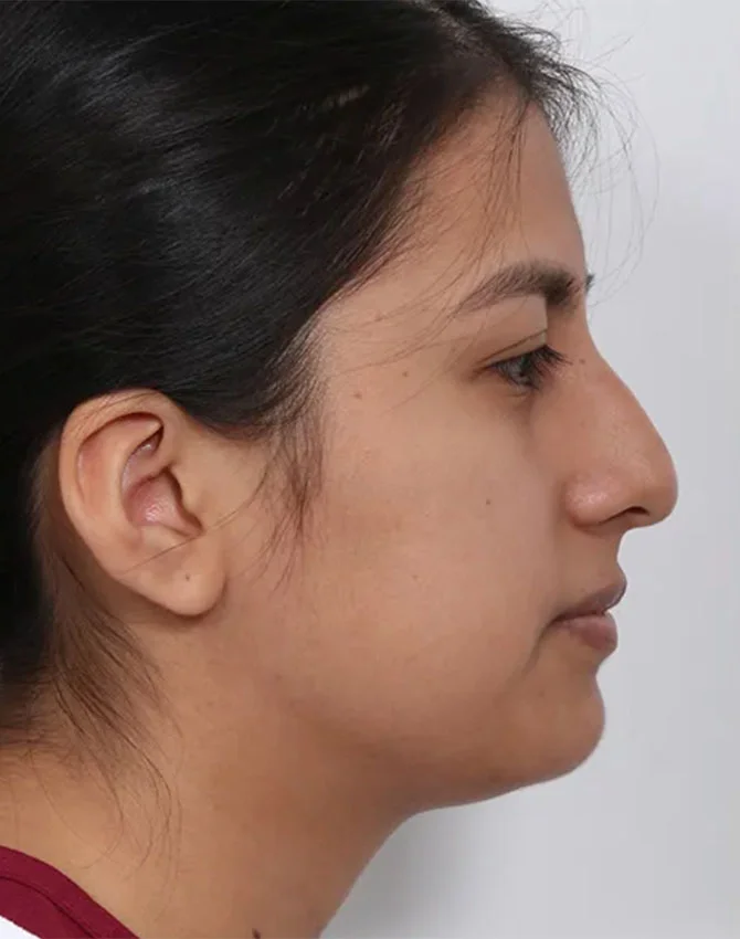 Real female patient before Rhinoplasty surgery