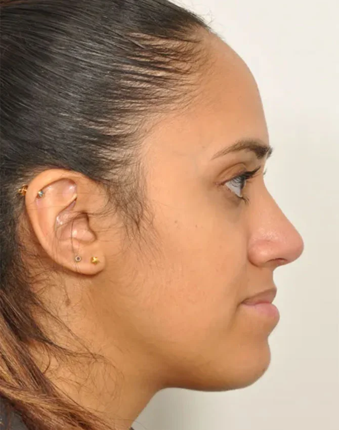 Real female patient after Rhinoplasty surgery