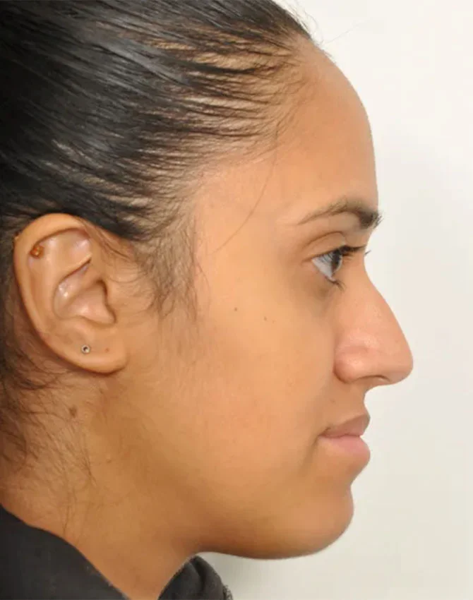 Real female patient before Rhinoplasty surgery