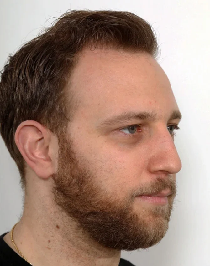 Real patient male hair transplant after procedure shows beautiful results