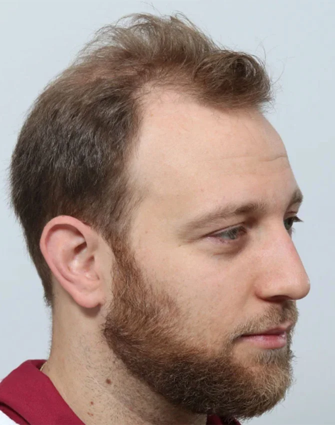 Real patient male hair transplant before procedure