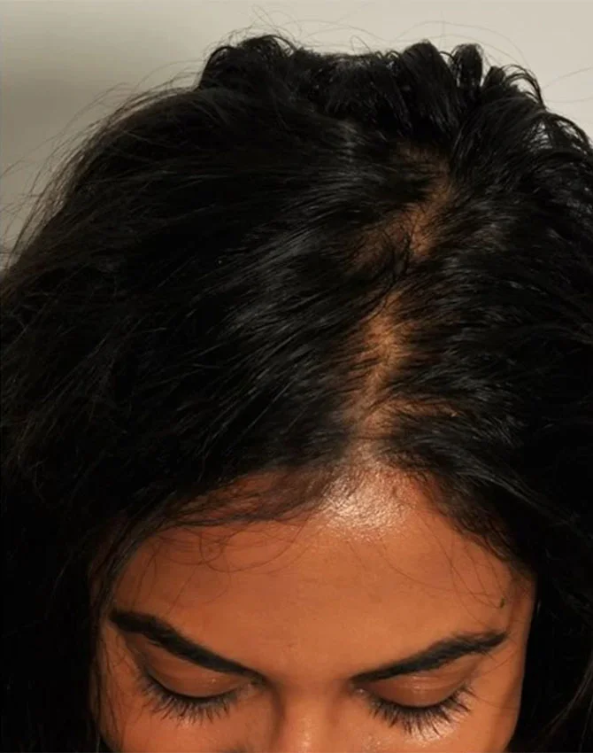 Real female patient PRP Hair Treatment after photo