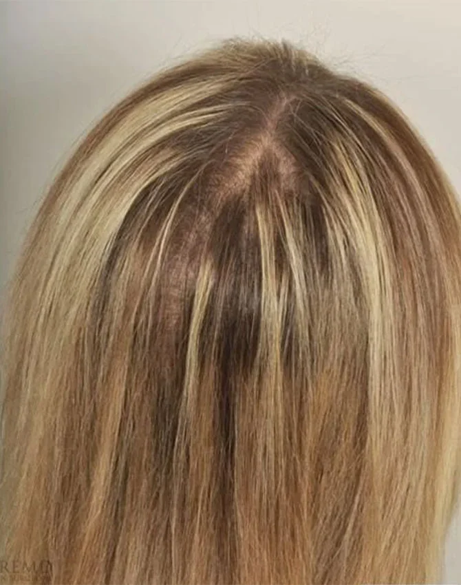 Real patient PRP Hair Treatment after photo