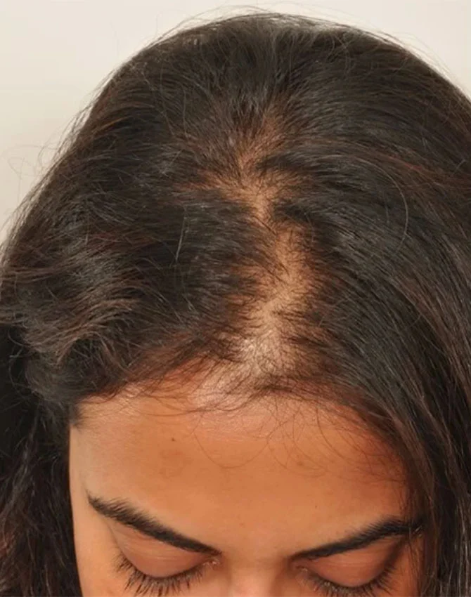 Real female patient PRP Hair Treatment before photo