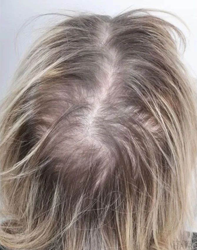 Real patient PRP Hair Treatment before photo