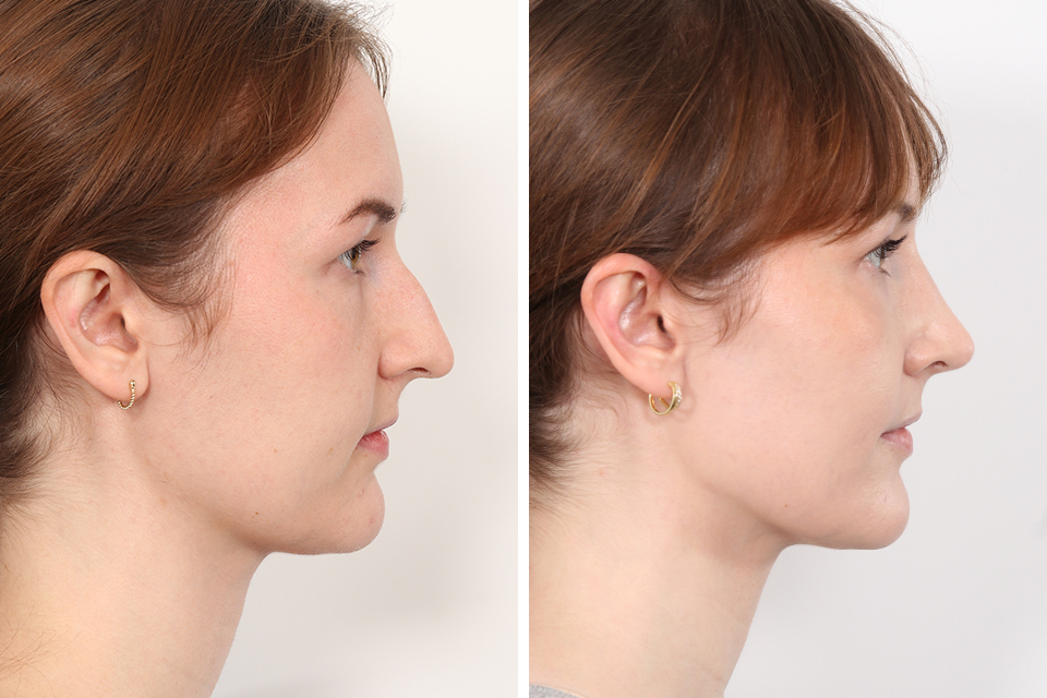 Rhinoplasty