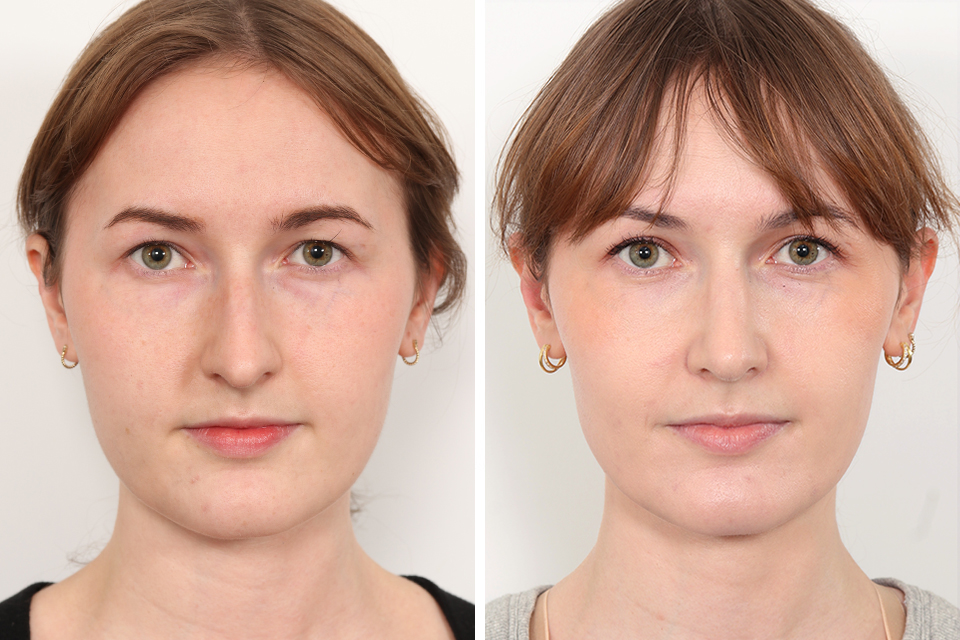 Rhinoplasty
