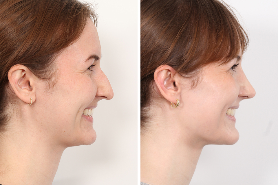 Rhinoplasty