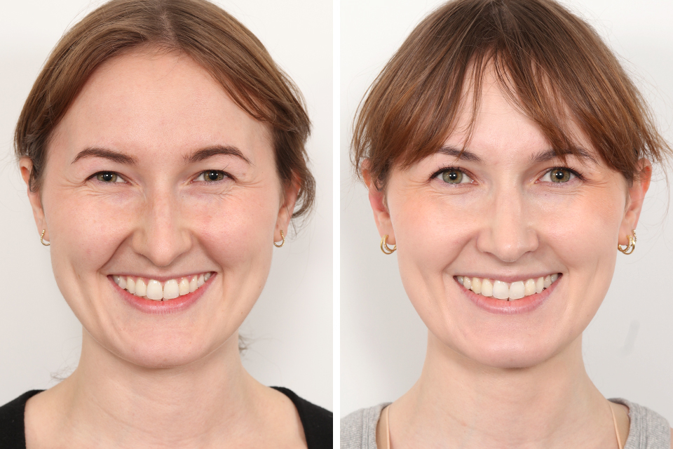Rhinoplasty