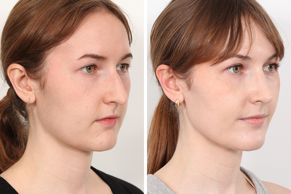 Rhinoplasty