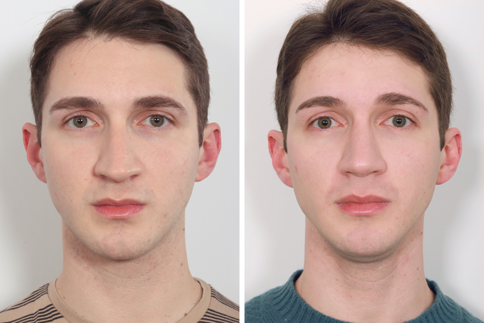 Male Rhinoplasty