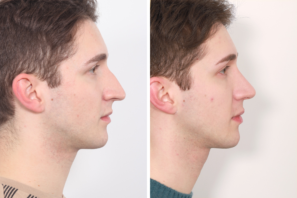 Male Rhinoplasty