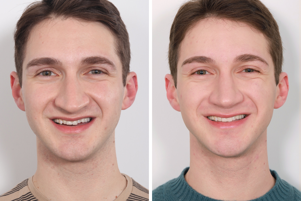 Male Rhinoplasty