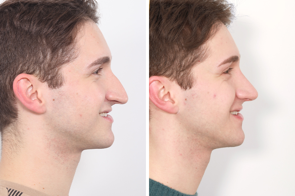 Male Rhinoplasty