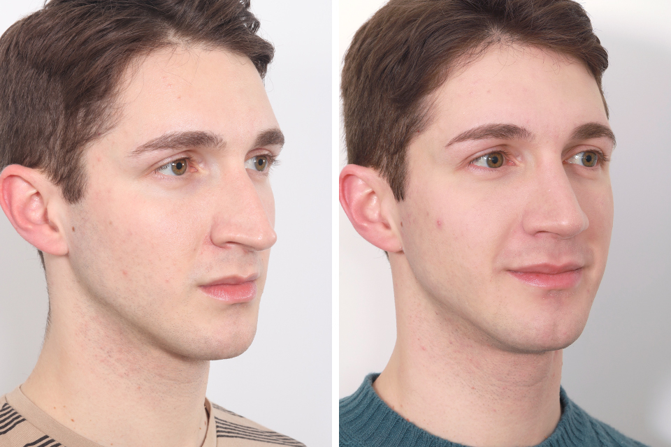 Male Rhinoplasty