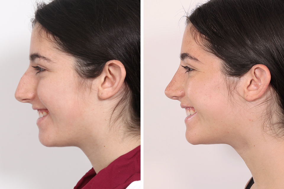 Rhinoplasty