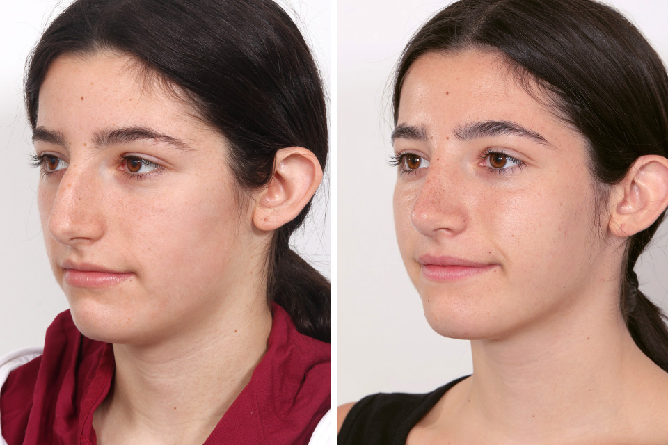 Rhinoplasty