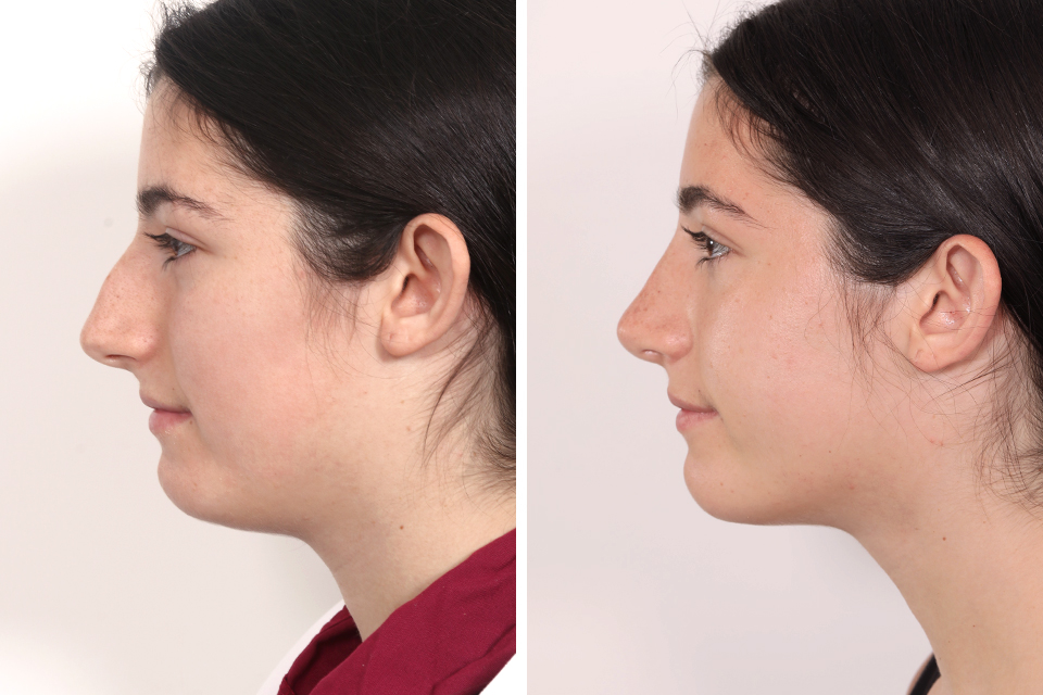 Rhinoplasty
