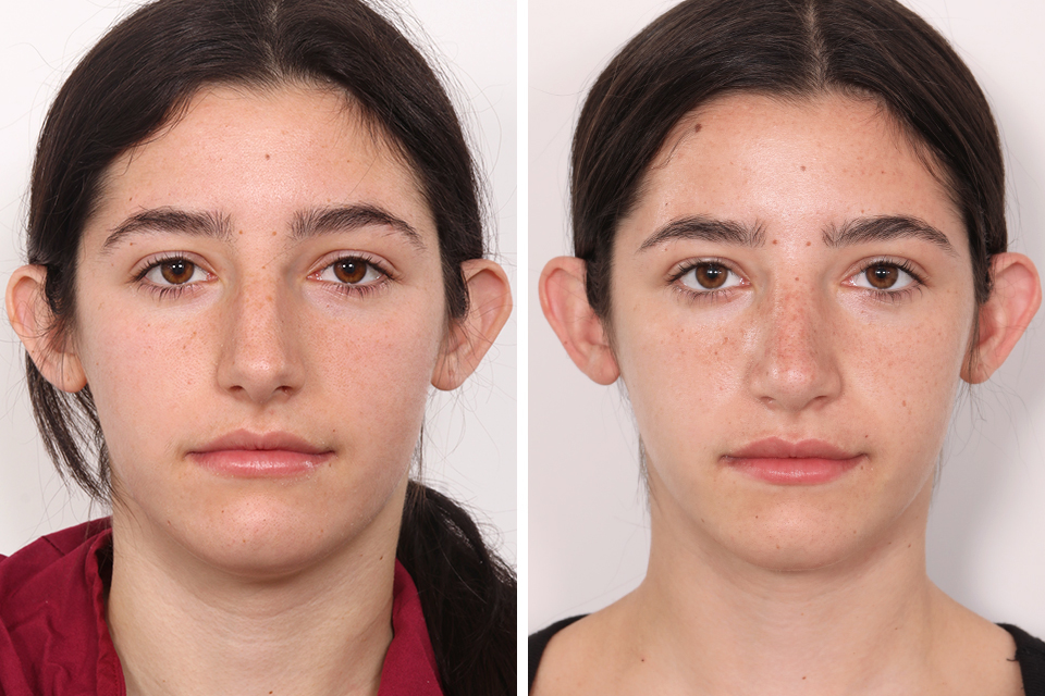 Rhinoplasty