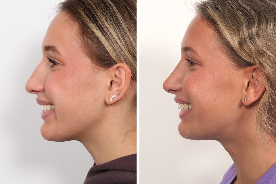 Rhinoplasty
