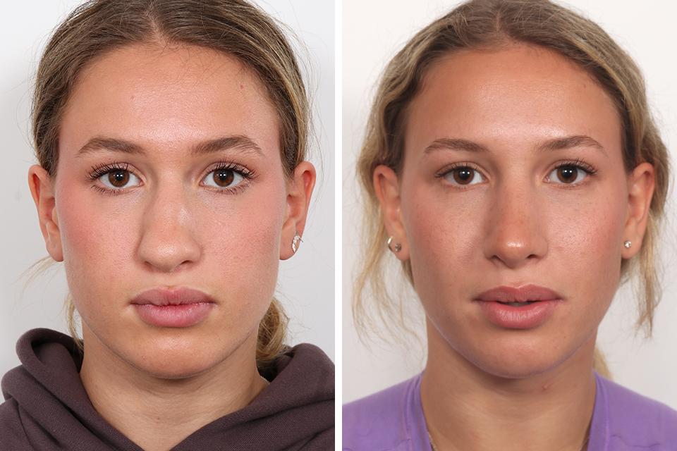 Rhinoplasty