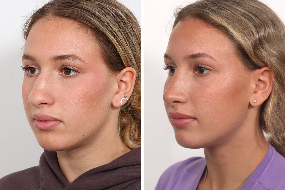 Rhinoplasty