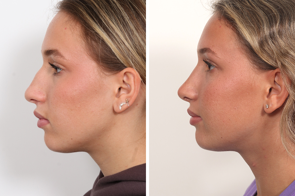 Rhinoplasty