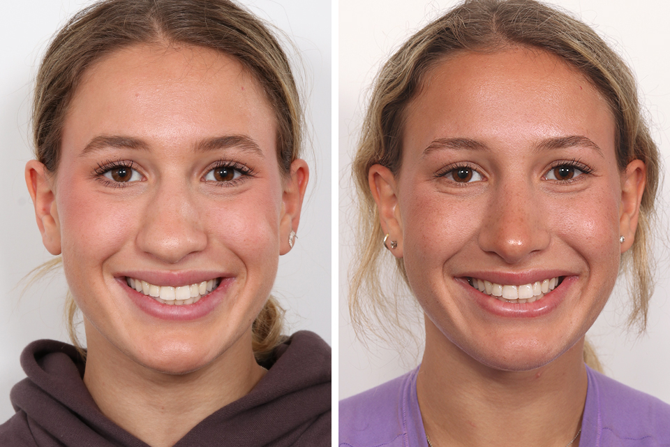 Rhinoplasty