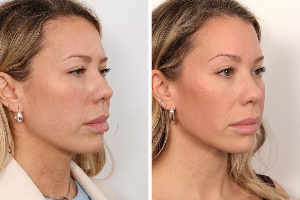 Endoscopic Brow Lift