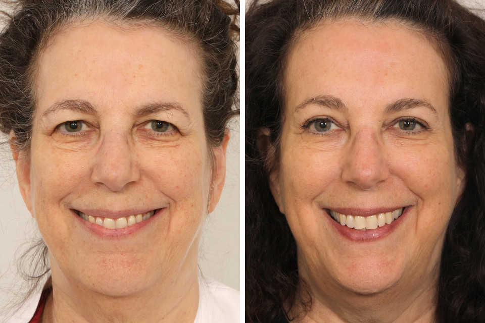 Endoscopic Brow Lift