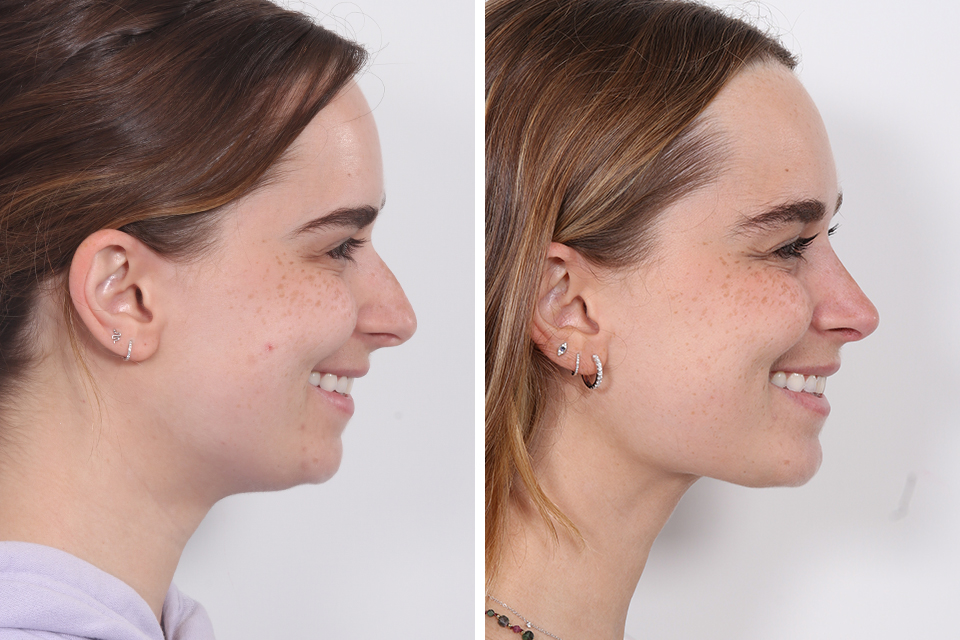 Rhinoplasty