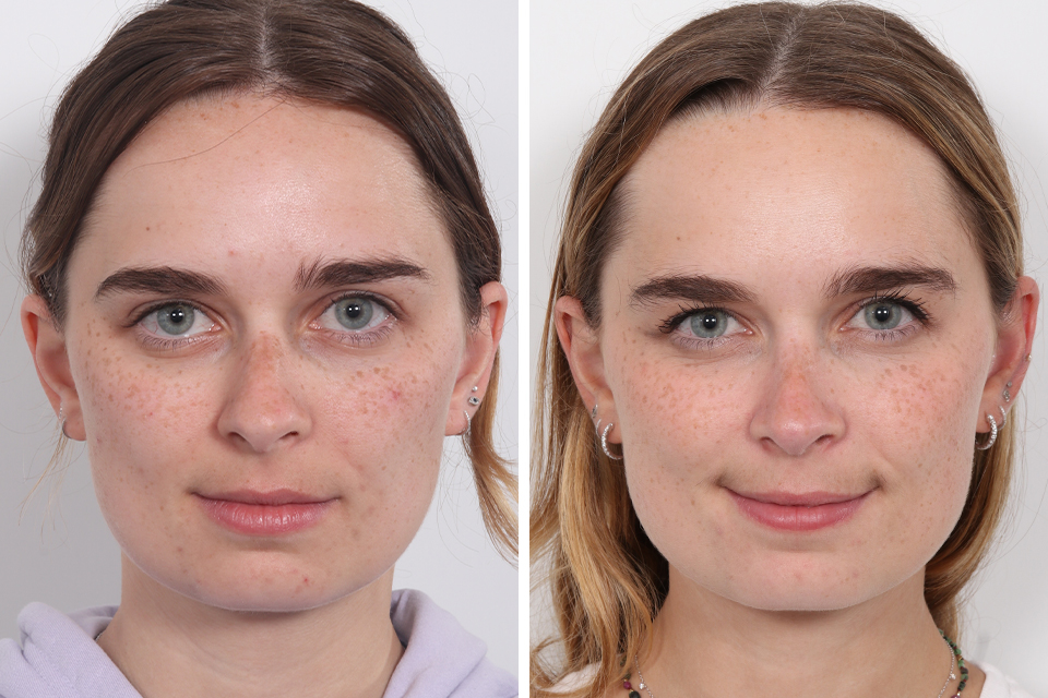 Rhinoplasty
