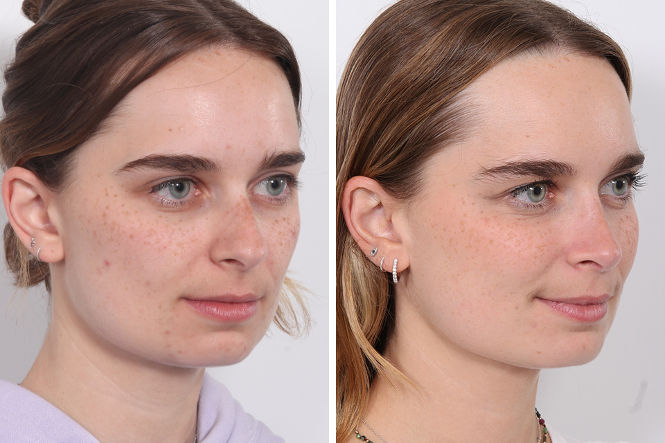 Rhinoplasty