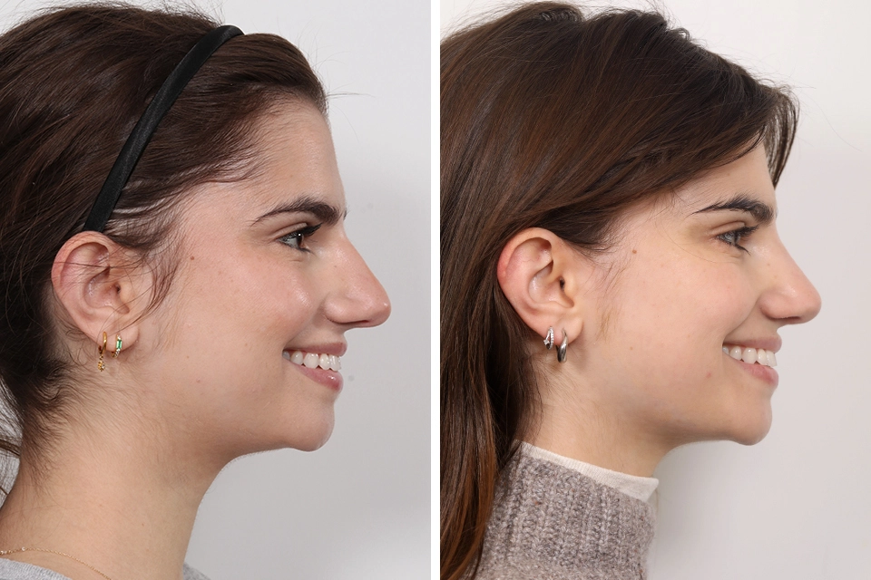 Rhinoplasty
