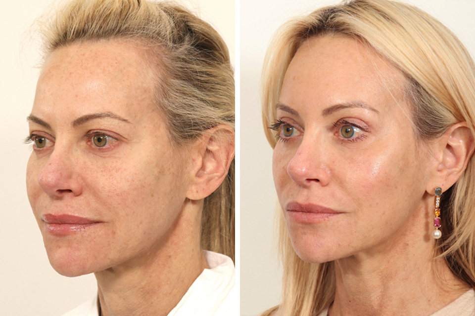 Endoscopic Brow Lift