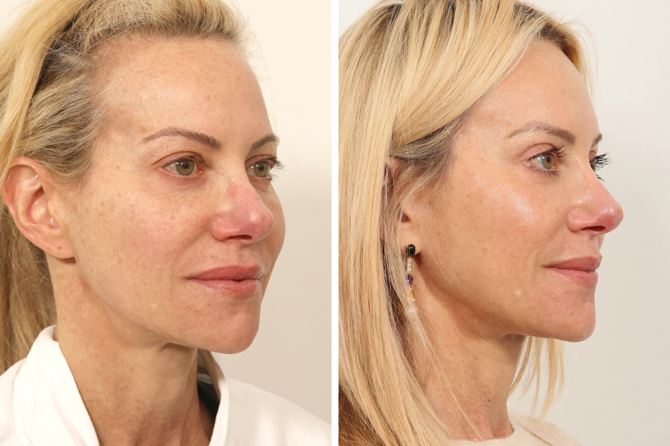 Endoscopic Brow Lift
