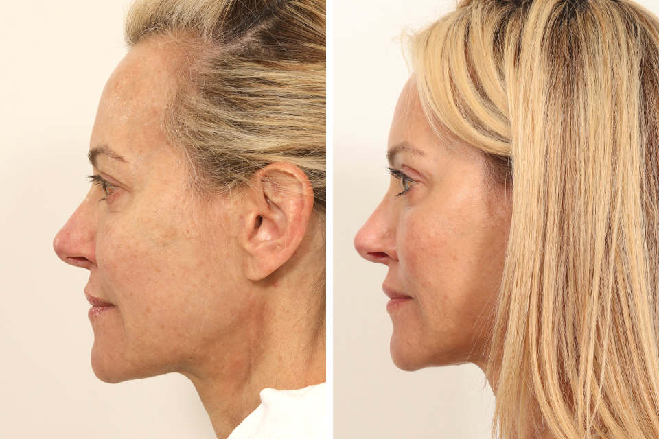 Endoscopic Brow Lift