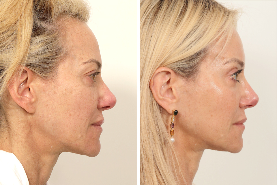 Endoscopic Brow Lift