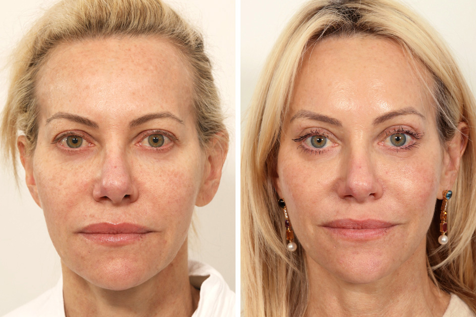 Endoscopic Brow Lift