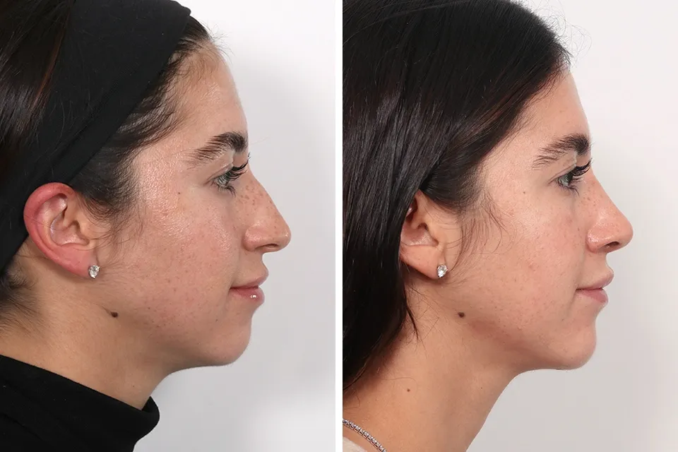 Rhinoplasty