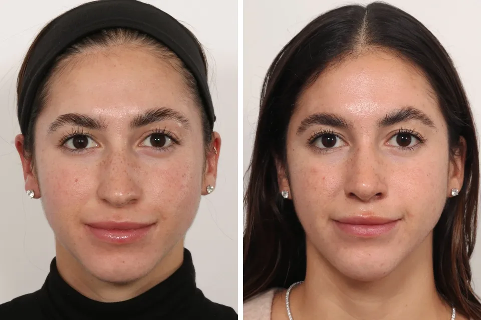 Rhinoplasty