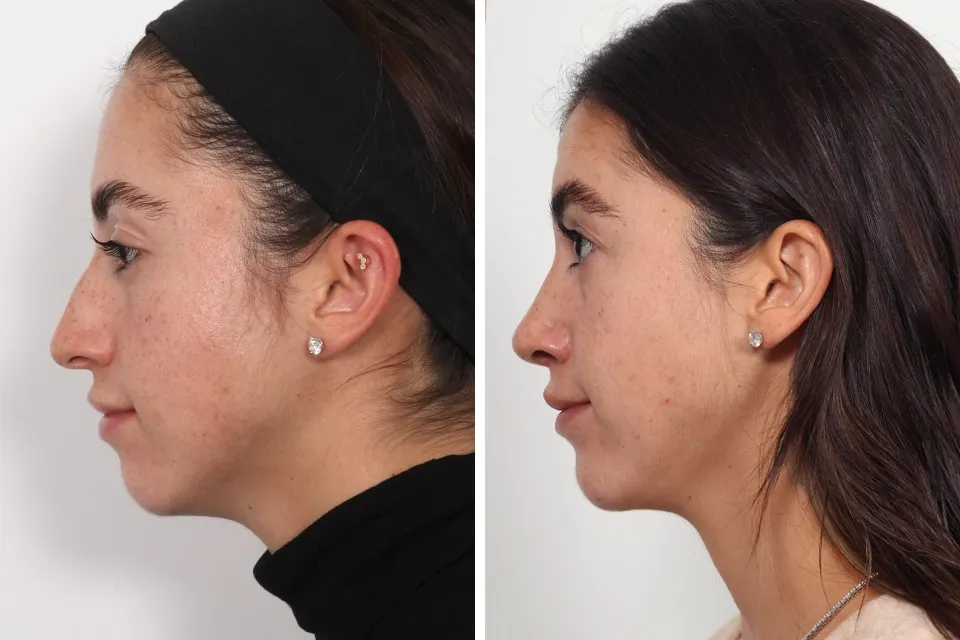 Rhinoplasty